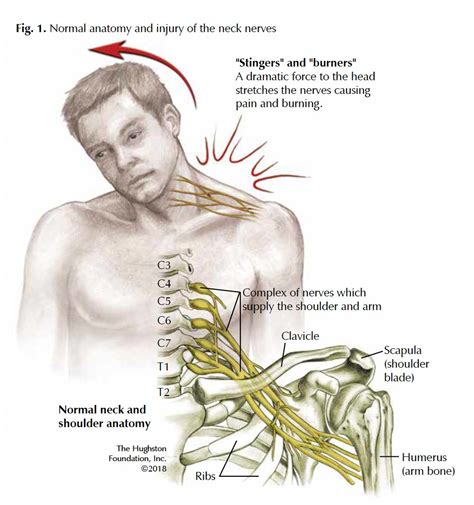 National Center for Biotechnology Information. . What happens when you hit a nerve when giving an injection